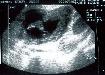 tnweb_06foot_19wks.jpg